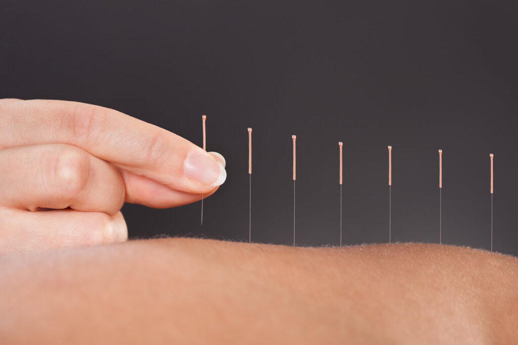 acupuncture services