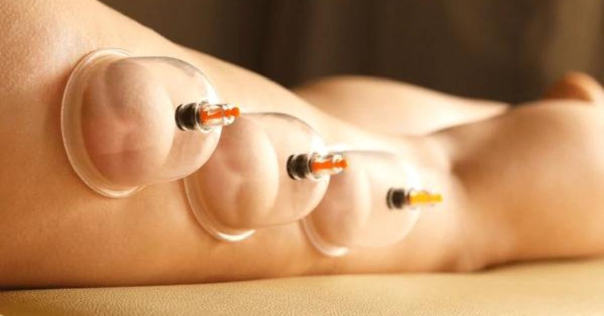 cupping therapy for cellulite